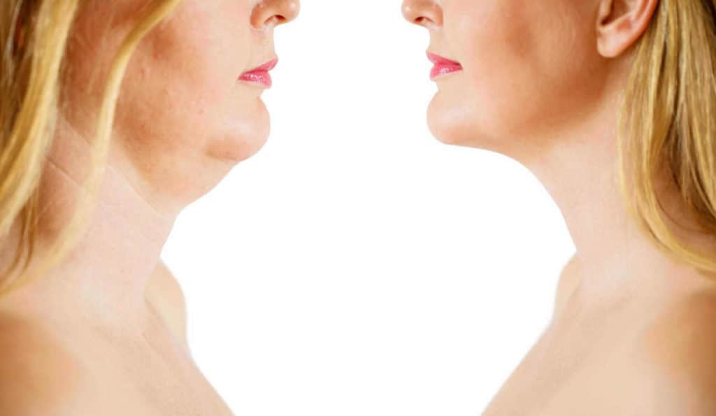 Double Chin treatment Worthing before and after results