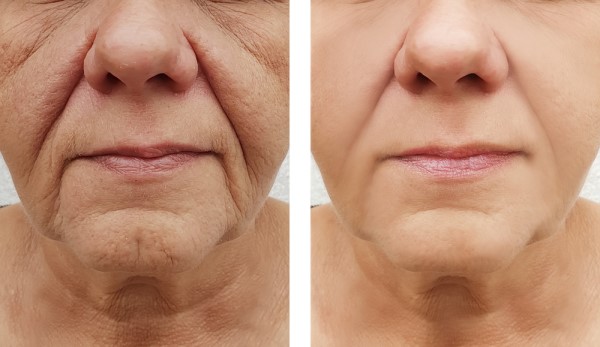 Learn more about Morpheus8 Treatment Worthing today!