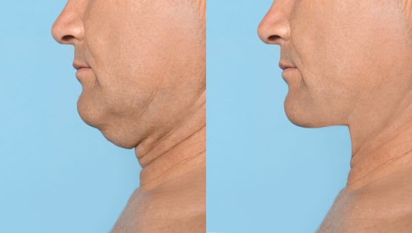 Which Non-Surgical Treatments Work Best for Jowls and Loose Skin Worthing?