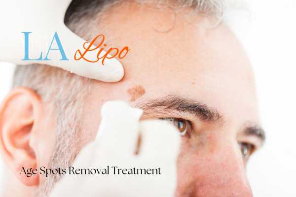 What Are the Most Effective Treatments for Age Spots Worthing?