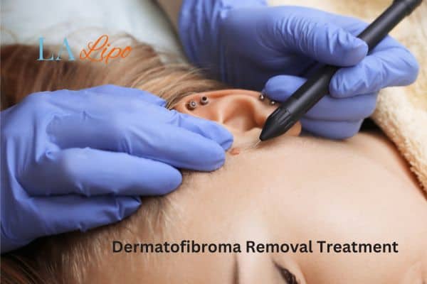Dermatofibroma Removal Treatment Worthing