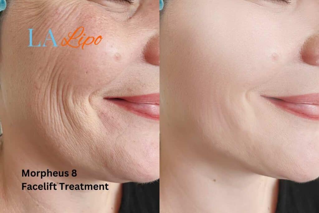 Morpheus8 Treatment Worthing for flawless skin! Call us today!