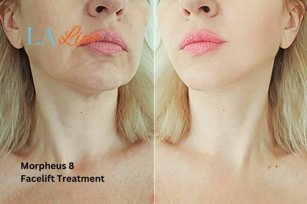Turn back time with Morpheus8 Treatment Worthing