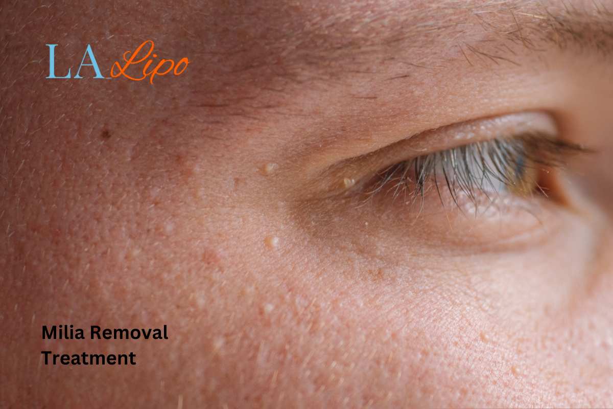 Cryopen Milia Removal: Is It the Easiest and Safest Option Worthing?