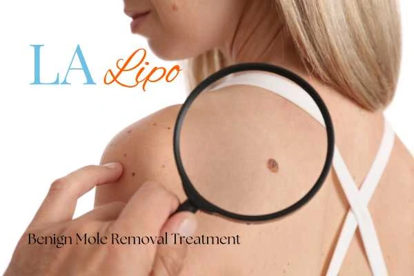Why getting moles removed Worthing can boost your confidence!