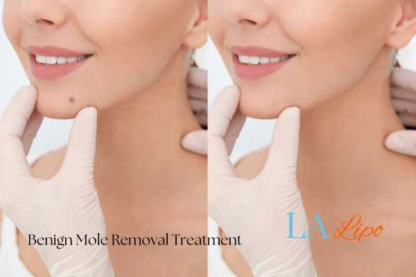 woman's before and after mole removal Worthing results