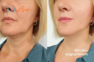 hi-fu for wrinkles Worthing before and after results