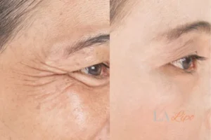 Before and after results of woman - HI-fu wrinkles reduction treatment Worthing