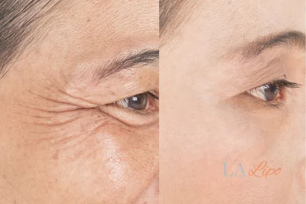 Before and after results of woman - HI-fu wrinkles reduction treatment Worthing
