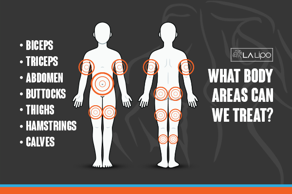 Graphic to show areas you can have LA-EMS Body Sculpting Worthing treatment.