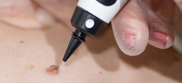 skin tag removal using cryopen Worthing