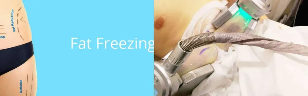 Fat freezing Worthing on multiple areas of the body