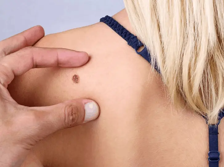 woman having mole removal Worthing consultation before treatment.