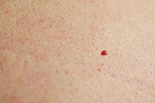 close up of a cherry angioma Worthing