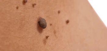 image of a skin tag Worthing