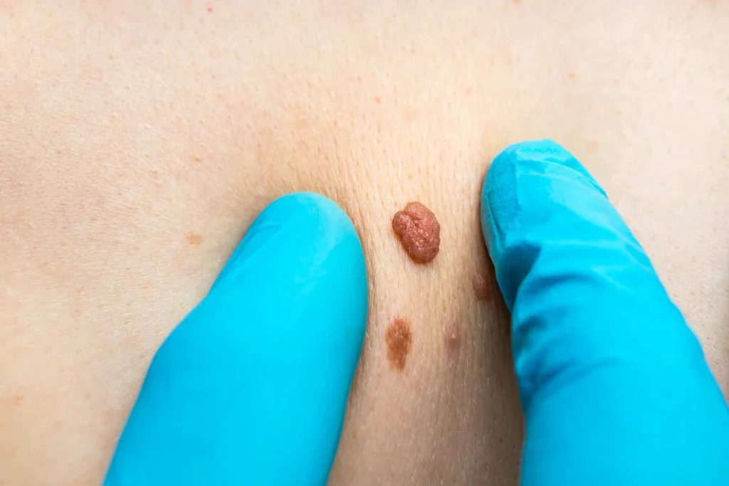 Consultant examining a skin tag Worthing