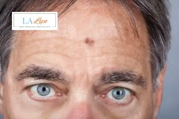 Solar Lentigo Removal Worthing image of man with mark on his forehead