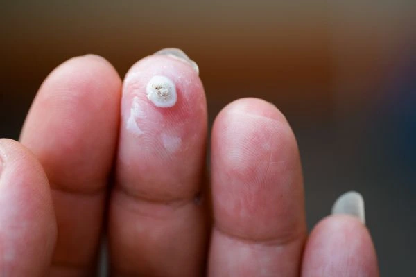 wart on person finger - cryotherapy to treat from LA LIPO Worthing