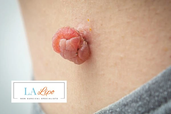 Interested in skin tag removal Worthing? Concerned about the pain? Find out more today!