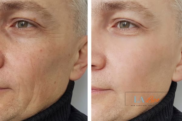 See the amazing results of Morpheus8 Treatment Worthing!