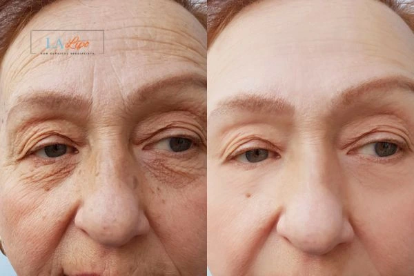 The powerful benefits of Morpheus8 Treatment Worthing - Call Our team today!