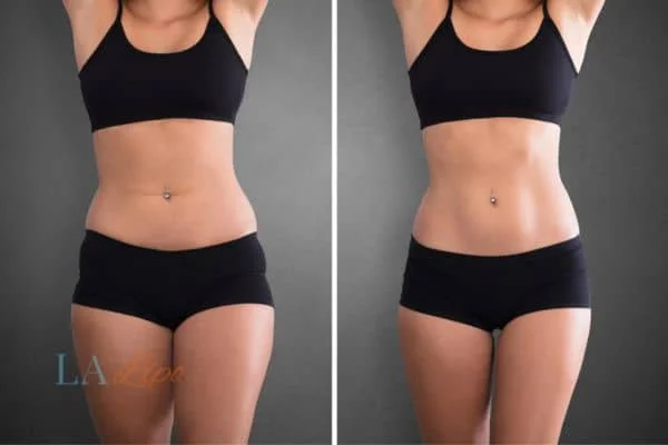 before and after results of non-surgical treatment to help a woman's body image and mental health Worthing