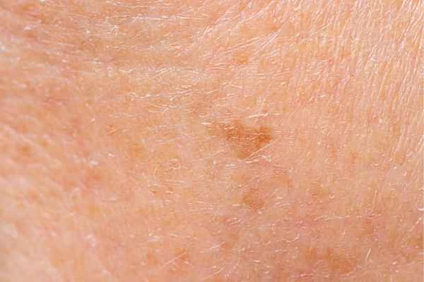 close up picture of age spots Worthing