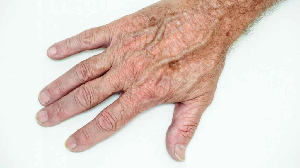 Male hand showing age spot Worthing