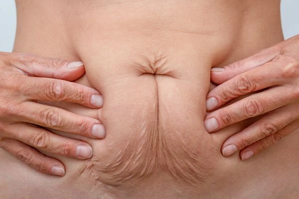 Should I Combine Diastasis Recti Treatment with Body Contouring for Better Results Worthing?